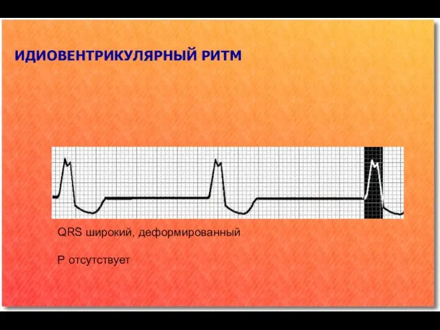 ИДИОВЕНТРИКУЛЯРНЫЙ РИТМ QRS широкий, деформированный Р отсутствует