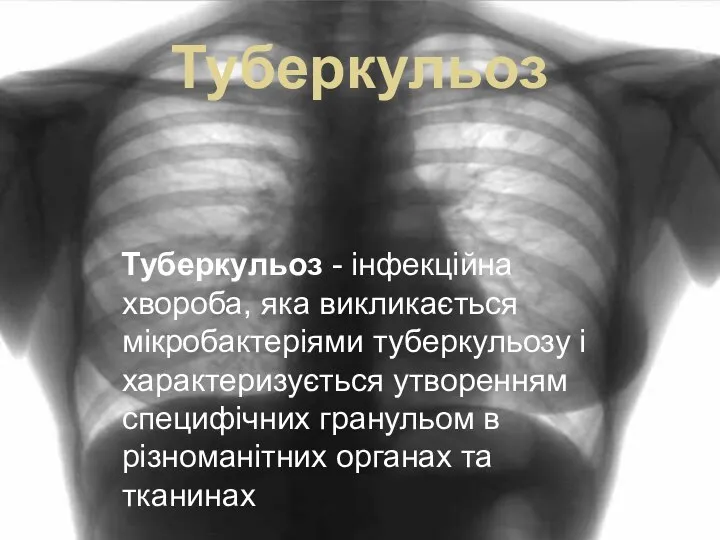 Туберкульоз Туберкульоз - інфекційна хвороба, яка викликається мікробактеріями туберкульозу і характеризується утворенням