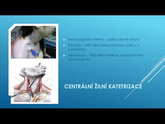 CENTRÁLNÍ ŽILNÍ KATETRIZACE Vena jugularis interna – spíše z pravé strany Výhody