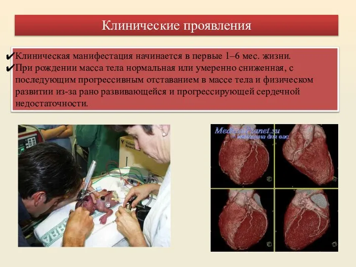 Клиническая манифестация начинается в первые 1–6 мес. жизни. При рождении масса тела