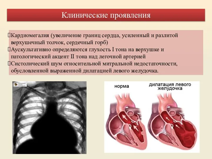 Кардиомегалия (увеличение границ сердца, усиленный и разлитой верхушечный толчок, сердечный горб) Аускультативно