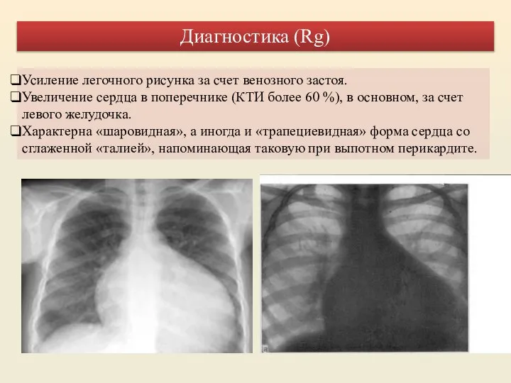 Усиление легочного рисунка за счет венозного застоя. Увеличение сердца в поперечнике (КТИ