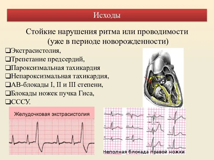 Стойкие нарушения ритма или проводимости (уже в периоде новорожденности) Экстрасистолия, Трепетание предсердий,