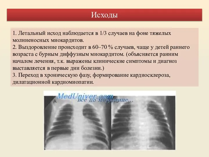 1. Летальный исход наблюдается в 1/3 случаев на фоне тяжелых молниеносных миокардитов.