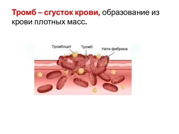 Тромб – сгусток крови, образование из крови плотных масс.