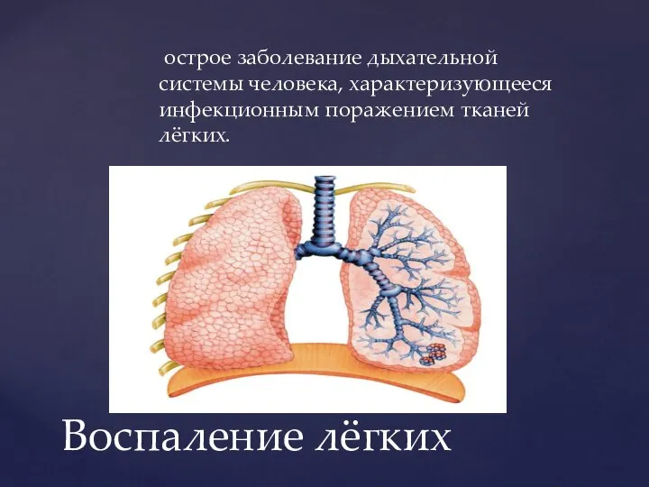 острое заболевание дыхательной системы человека, характеризующееся инфекционным поражением тканей лёгких. Воспаление лёгких