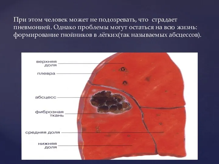 При этом человек может не подозревать, что страдает пневмонией. Однако проблемы могут