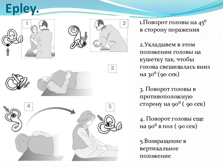 Лечение ДППГ ЗПК. Маневр Epley. 1.Поворот головы на 45⁰ в сторону поражения