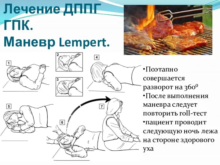 Лечение ДППГ ГПК. Маневр Lempert. •Поэтапно совершается разворот на 360⁰ •После выполнения