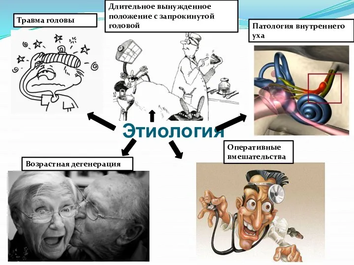 Этиология Травма головы Длительное вынужденное положение с запрокинутой головой Патология внутреннего уха Возрастная дегенерация Оперативные вмешательства