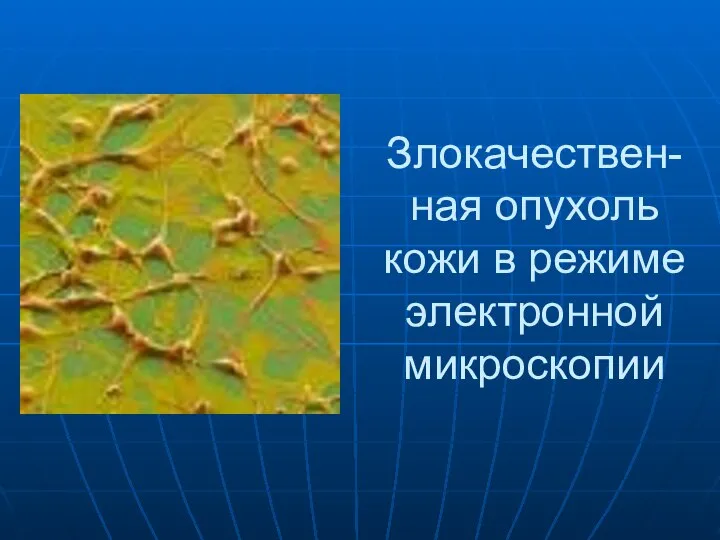Злокачествен- ная опухоль кожи в режиме электронной микроскопии