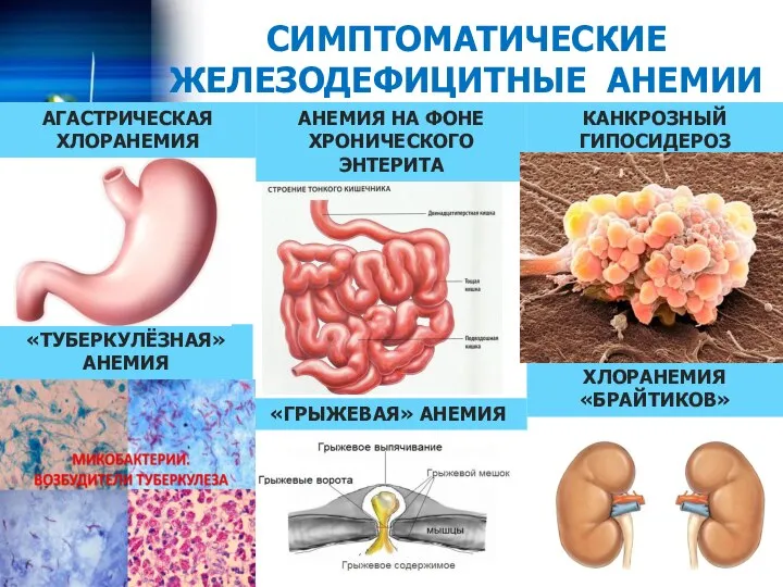 СИМПТОМАТИЧЕСКИЕ ЖЕЛЕЗОДЕФИЦИТНЫЕ АНЕМИИ АНЕМИЯ НА ФОНЕ ХРОНИЧЕСКОГО ЭНТЕРИТА АГАСТРИЧЕСКАЯ ХЛОРАНЕМИЯ «ГРЫЖЕВАЯ» АНЕМИЯ