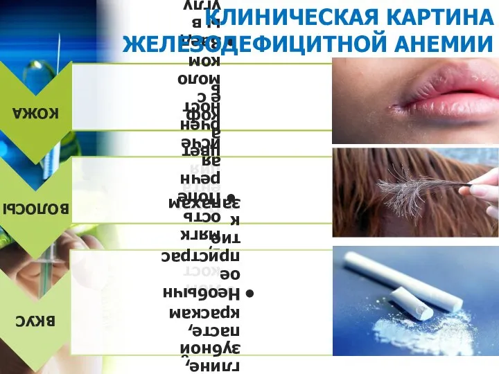 КЛИНИЧЕСКАЯ КАРТИНА ЖЕЛЕЗОДЕФИЦИТНОЙ АНЕМИИ