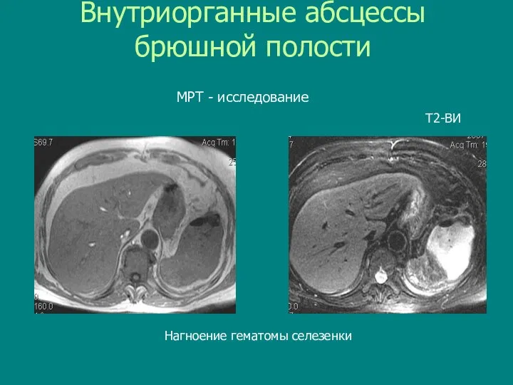 Внутриорганные абсцессы брюшной полости Нагноение гематомы селезенки Т2-ВИ МРТ - исследование