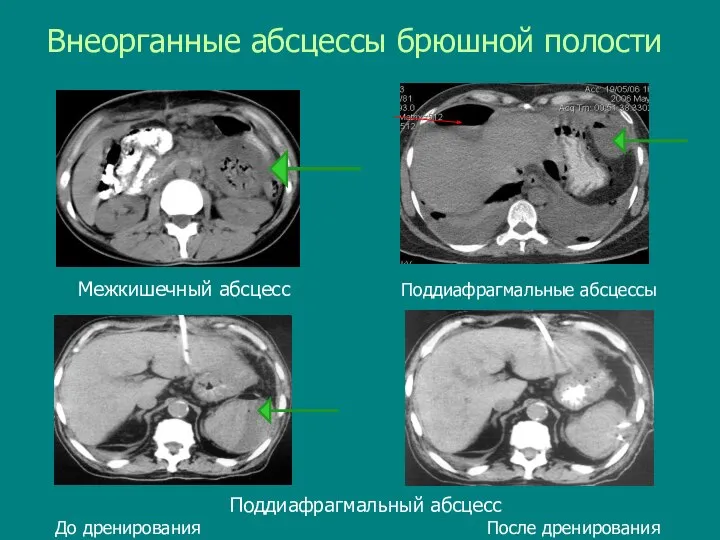 Внеорганные абсцессы брюшной полости Межкишечный абсцесс Поддиафрагмальный абсцесс До дренирования После дренирования Поддиафрагмальные абсцессы