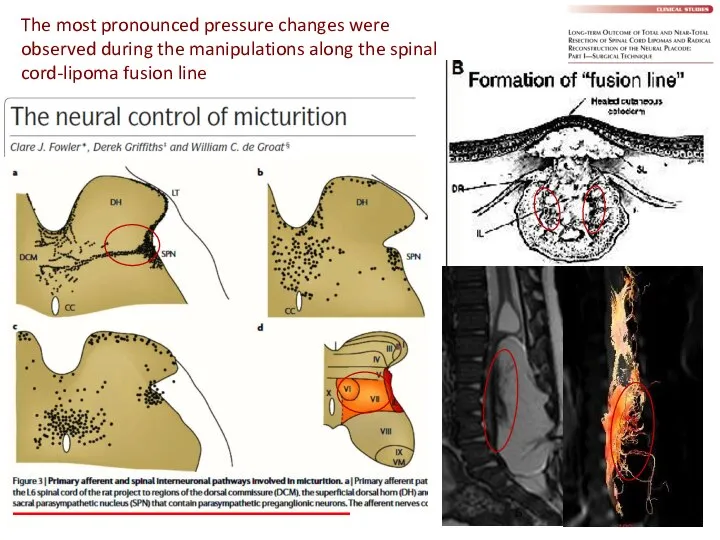 The most pronounced pressure changes were observed during the manipulations along the spinal cord-lipoma fusion line