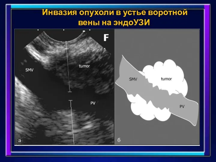 Инвазия опухоли в устье воротной вены на эндоУЗИ