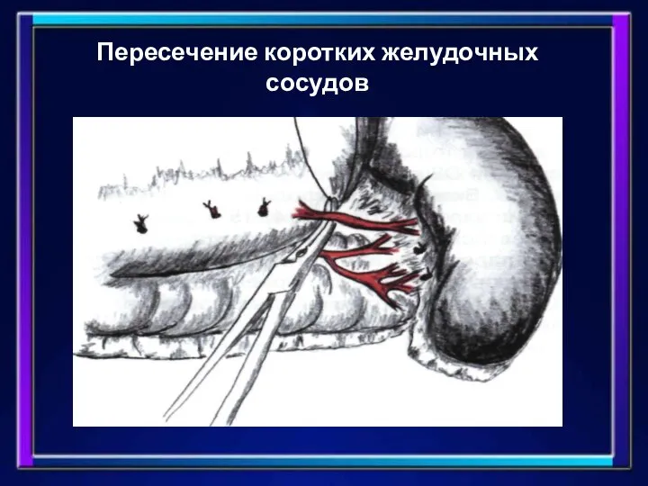 Пересечение коротких желудочных сосудов