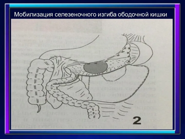 Мобилизация селезеночного изгиба ободочной кишки