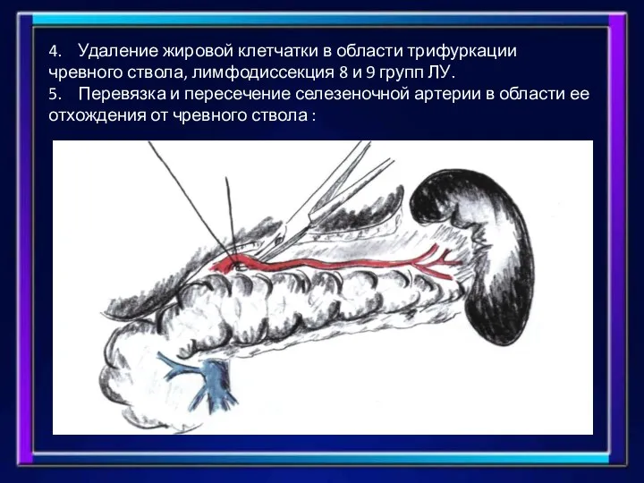 4. Удаление жировой клетчатки в области трифуркации чревного ствола, лимфодиссекция 8 и