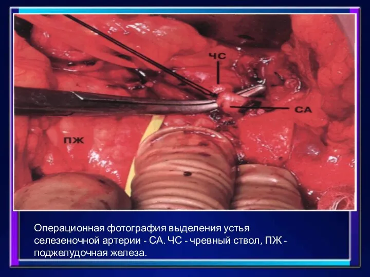 Операционная фотография выделения устья селезеночной артерии - СА. ЧС - чревный ствол, ПЖ - поджелудочная железа.