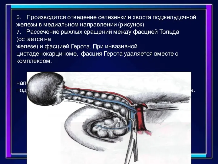 6. Производится отведение селезенки и хвоста поджелудочной железы в медиальном направлении (рисунок).