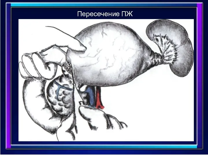 Пересечение ПЖ