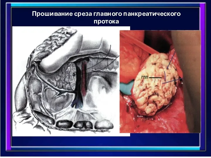 Прошивание среза главного панкреатического протока