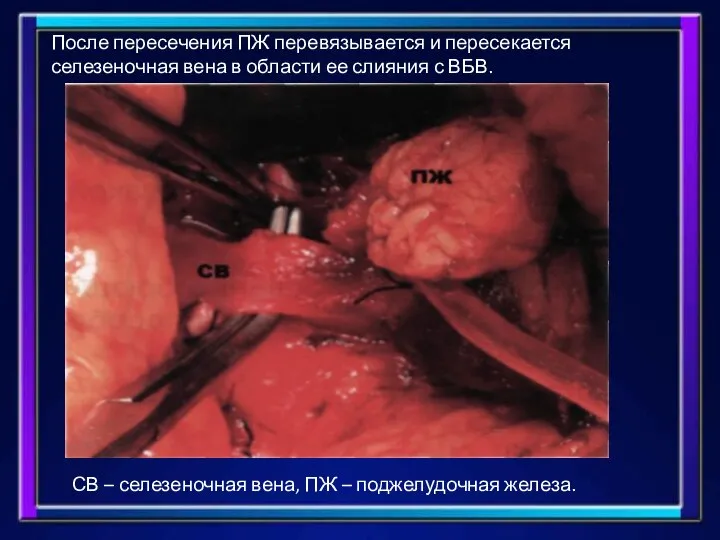 После пересечения ПЖ перевязывается и пересекается селезеночная вена в области ее слияния