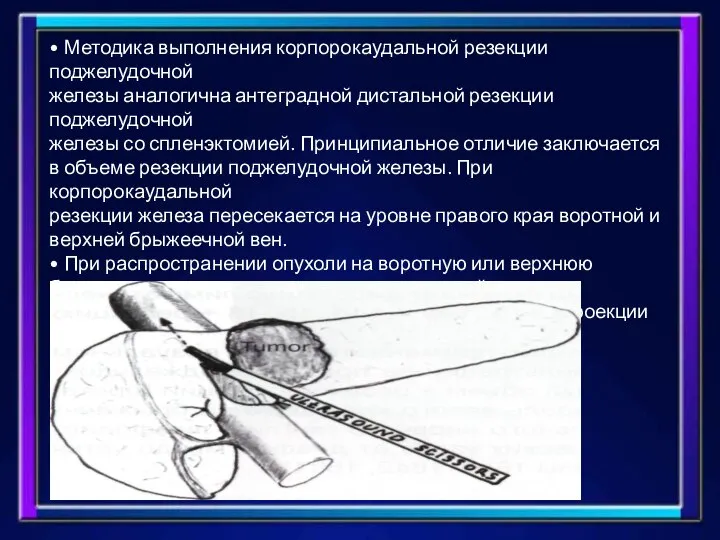 • Методика выполнения корпорокаудальной резекции поджелудочной железы аналогична антеградной дистальной резекции поджелудочной