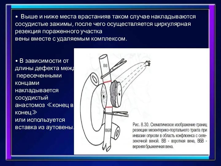 • Выше и ниже места врастанияв таком случае накладываются сосудистые зажимы, после