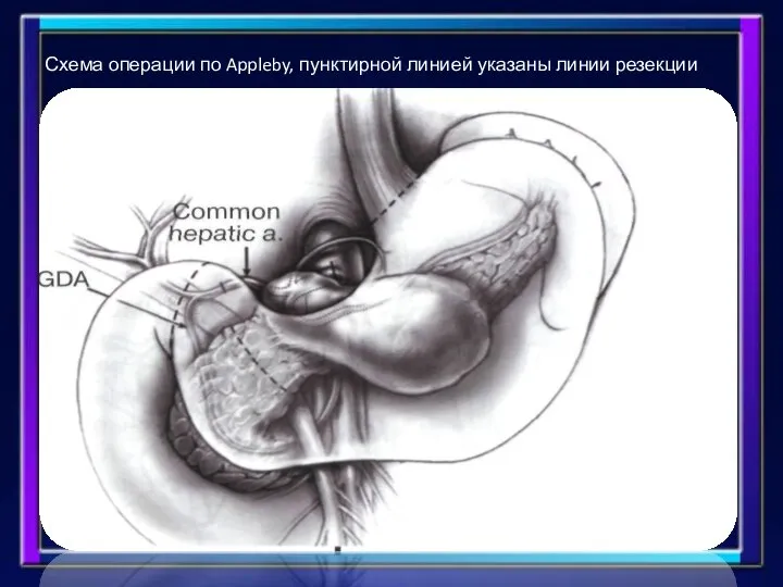 Схема операции по Appleby, пунктирной линией указаны линии резекции