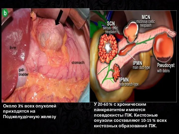 В Около 3% всех опухолей приходятся на Поджелудочную железу У 20-60 %