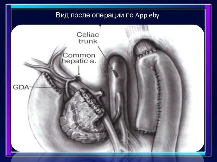 Вид после операции по Appleby