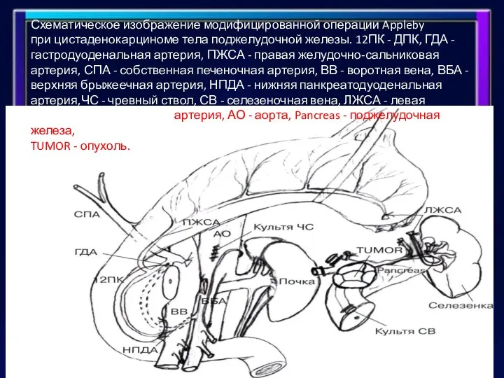 Схематическое изображение модифицированной операции Appleby при цистаденокарциноме тела поджелудочной железы. 12ПК -