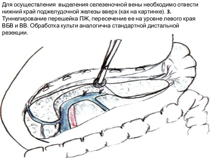 Для осуществления выделения селезеночной вены необходимо отвести нижний край поджелудочной железы вверх