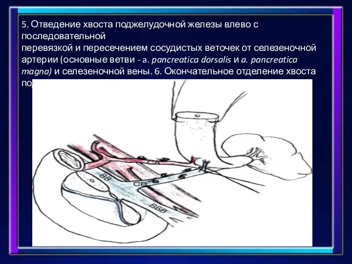 5. Отведение хвоста поджелудочной железы влево с последовательной перевязкой и пересечением сосудистых