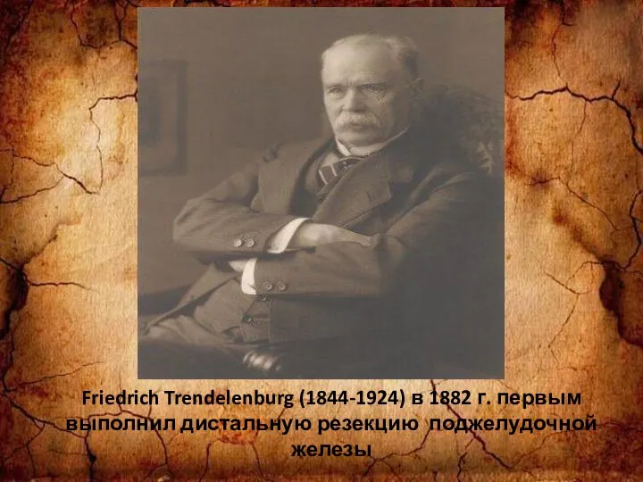 Friedrich Trendelenburg (1844-1924) в 1882 г. первым выполнил дистальную резекцию поджелудочной железы