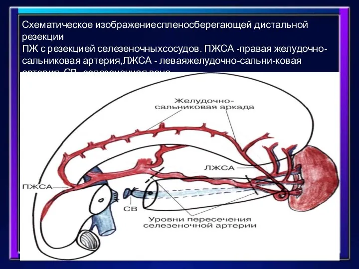 Схематическое изображениеспленосберегающей дистальной резекции ПЖ с резекцией селезеночныхсосудов. ПЖСА -правая желудочно-сальниковая артерия,ЛЖСА