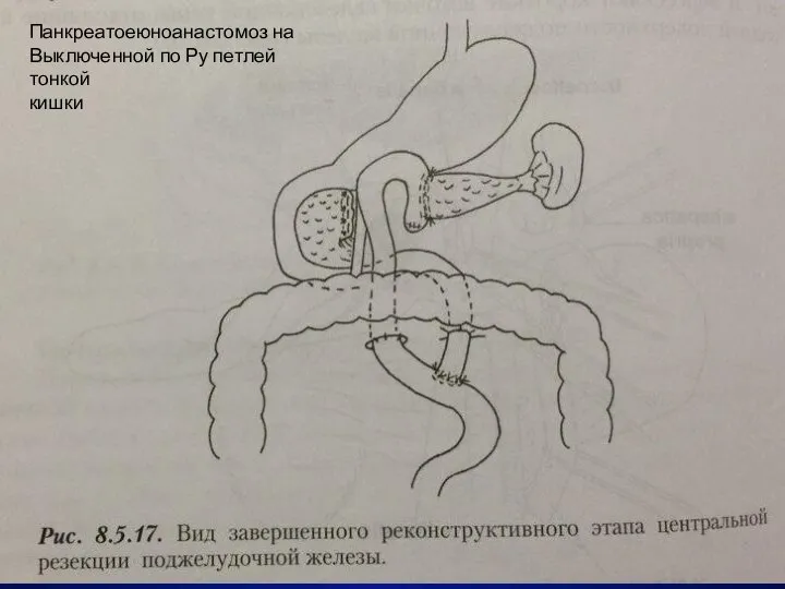 Панкреатоеюноанастомоз на Выключенной по Ру петлей тонкой кишки