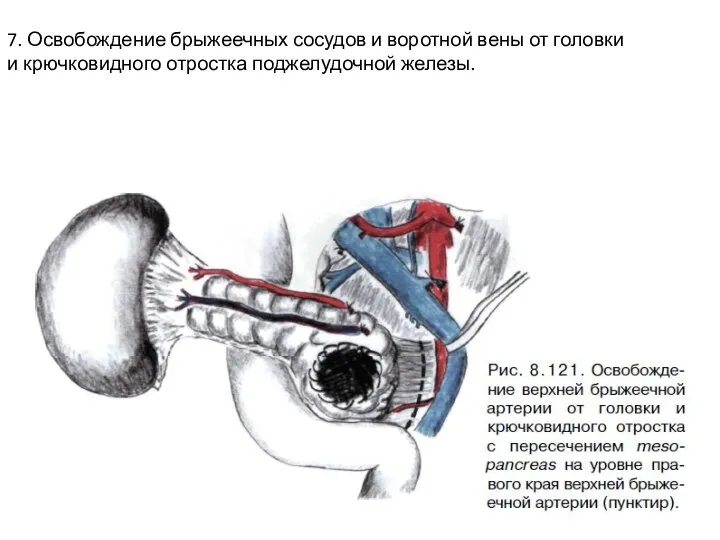 7. Освобождение брыжеечных сосудов и воротной вены от головки и крючковидного отростка поджелудочной железы.