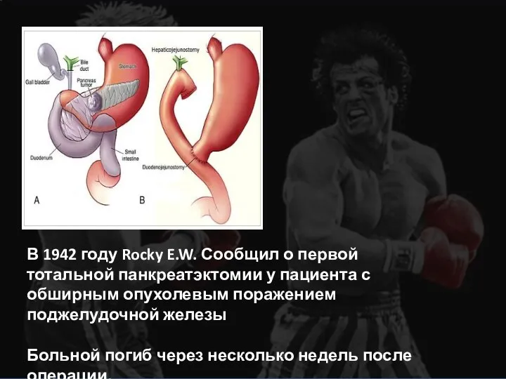 В 1942 году Rocky E.W. Сообщил о первой тотальной панкреатэктомии у пациента