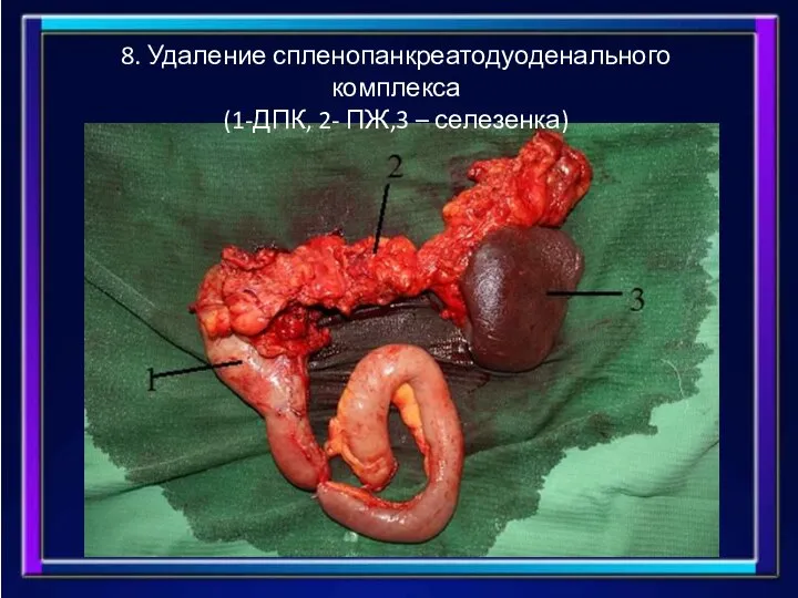 8. Удаление спленопанкреатодуоденального комплекса (1-ДПК, 2- ПЖ,3 – селезенка)