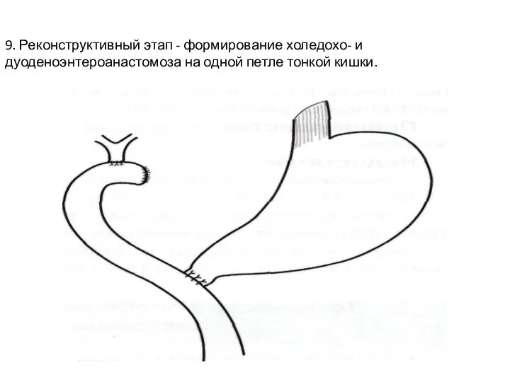 9. Реконструктивный этап - формирование холедохо- и дуоденоэнтероанастомоза на одной петле тонкой кишки.