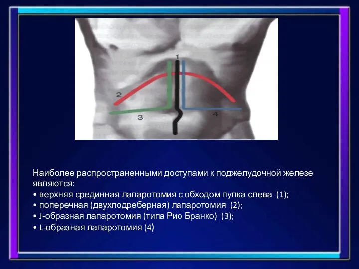 Наиболее распространенными доступами к поджелудочной железе являются: • верхняя срединная лапаротомия с
