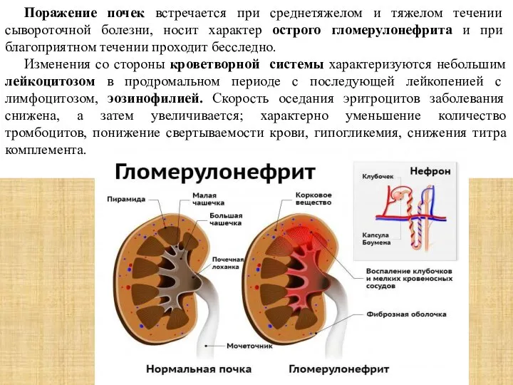 Поражение почек встречается при среднетяжелом и тяжелом течении сывороточной болезни, носит характер