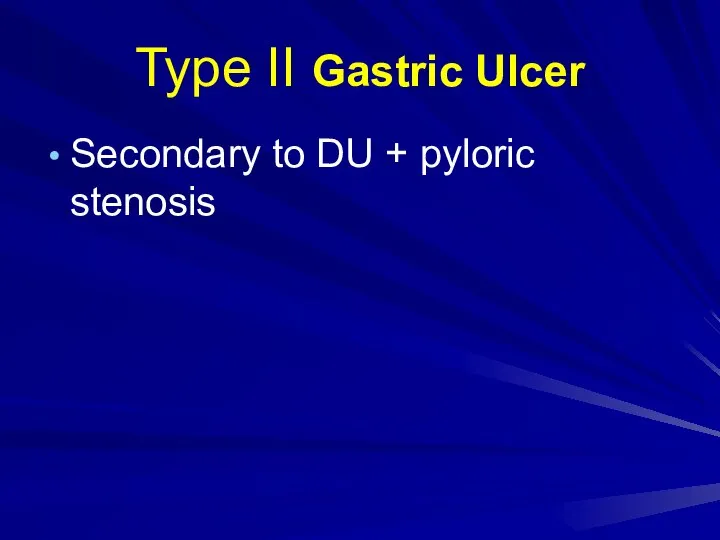 Type II Gastric Ulcer Secondary to DU + pyloric stenosis