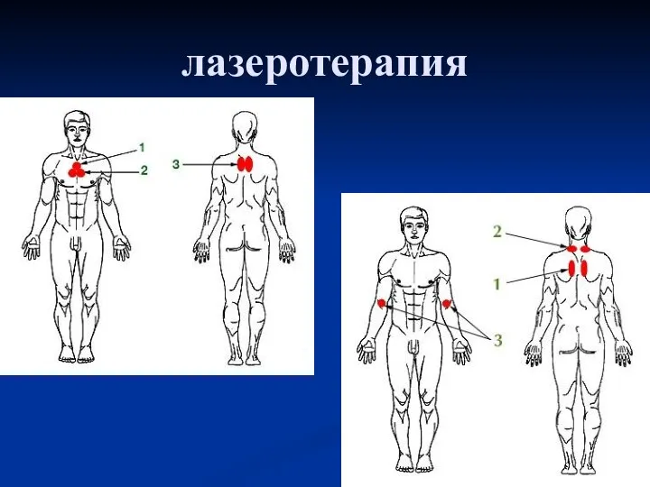 лазеротерапия