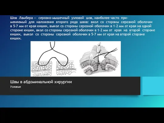 Швы в абдоминальной хирургии Узловые Шов Ламбера — серозно-мышечный узловой шов, наиболее