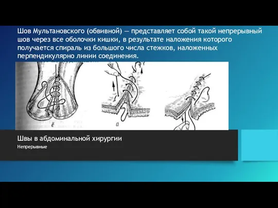 Швы в абдоминальной хирургии Непрерывные Шов Мультановского (обвивной) — представляет собой такой